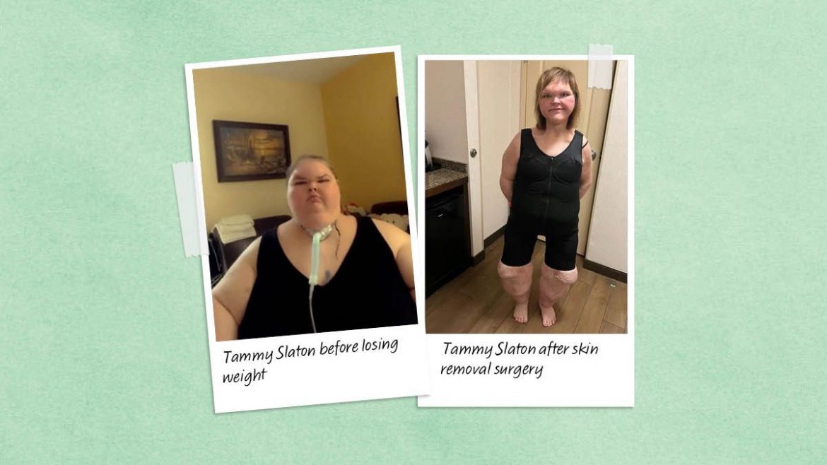 Tammy Slaton Shares Stunning New Photos After Skin Removal Surgery