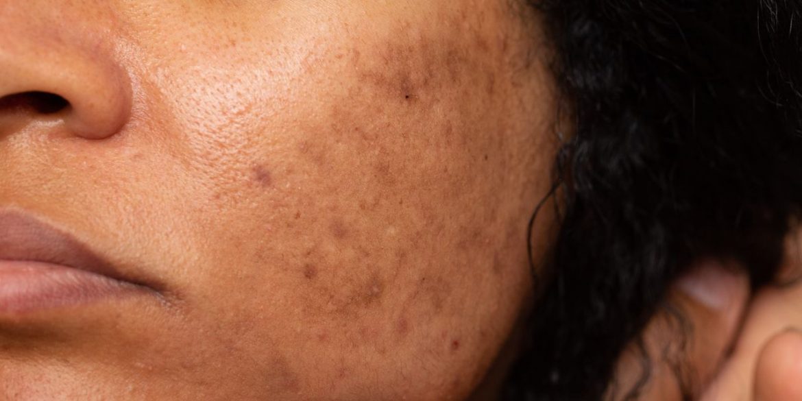 6 Skin Care Mistakes That Are Making Your Dark Spots Worse